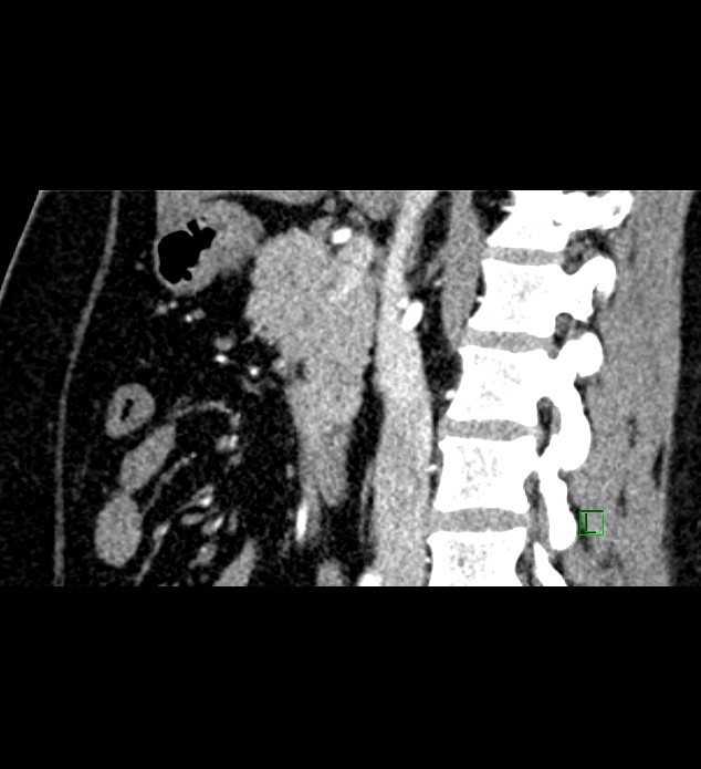 Chromophobe renal cell carcinoma (Radiopaedia 84286-99573 F 92).jpg