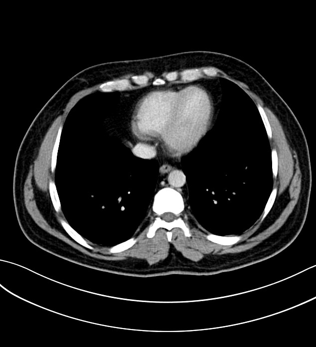 Chromophobe renal cell carcinoma (Radiopaedia 84286-99573 G 1).jpg