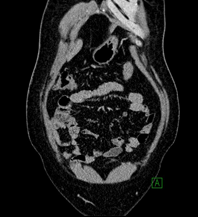 Chromophobe renal cell carcinoma (Radiopaedia 84286-99573 H 32).jpg