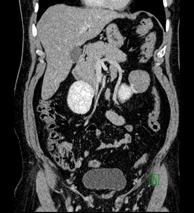 Chromophobe renal cell carcinoma (Radiopaedia 84286-99573 H 70).jpg
