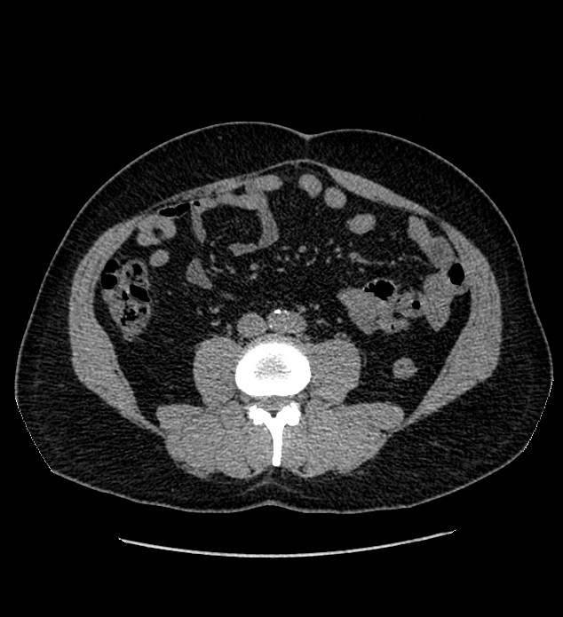 Chromophobe renal cell carcinoma (Radiopaedia 84337-99693 Axial non-contrast 84).jpg