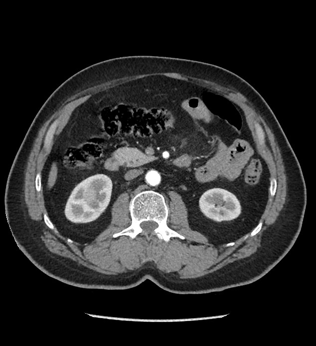 Chromophobe renal cell carcinoma (Radiopaedia 86879-103083 B 63).jpg