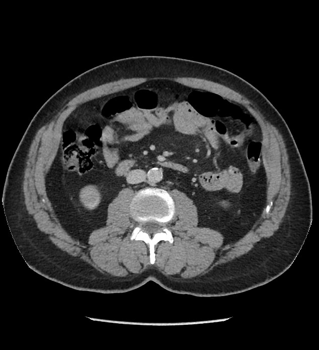 Chromophobe renal cell carcinoma (Radiopaedia 86879-103083 C 72).jpg