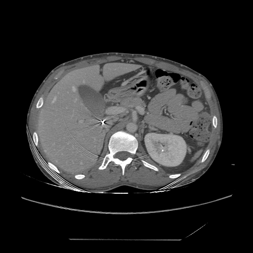 File:Chronic IVC thrombosis and resultant IVC filter malposition (Radiopaedia 81158-94800 A 55).jpg