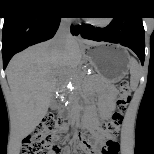 File:Chronic calcific pancreatitis (Radiopaedia 56280-62953 Coronal non-contrast 9).jpg