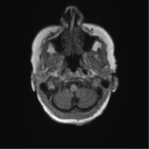 Chronic hypertensive encephalopathy (Radiopaedia 72844-83495 Axial T1 65).png