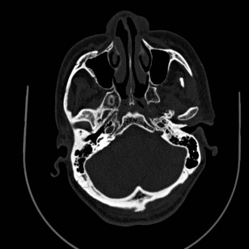 File:Chronic invasive fungal sinusitis (Radiopaedia 91563-109286 Axial sinus 28).jpg