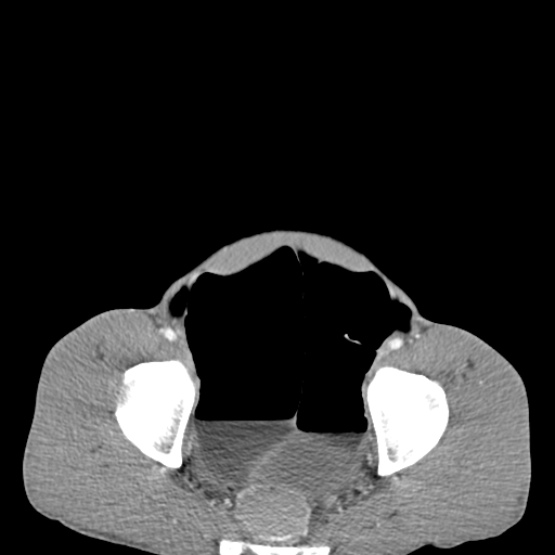 Chronic large bowel pseudo-obstruction (Radiopaedia 43181-46492 A 149).jpg