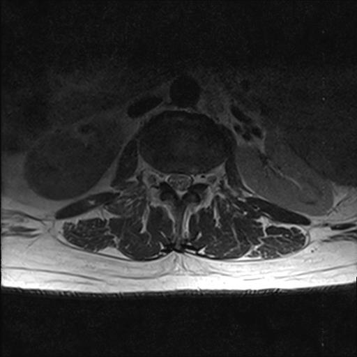 File:Chronic myeloid leukemia (MRI) (Radiopaedia 56128-62777 Axial T2 10).jpg