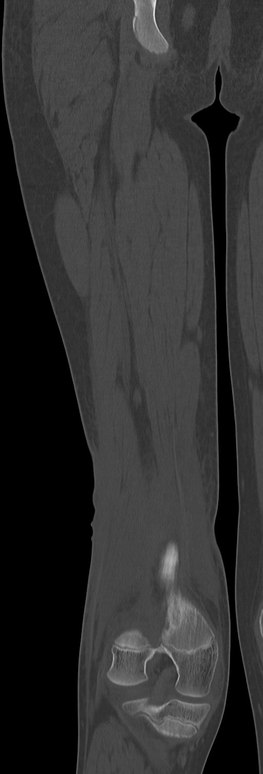Chronic ostemyelitis of the femur with long sinus tract (Radiopaedia 74947-85982 Coronal bone window 55).jpg
