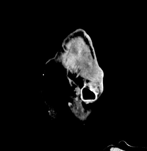 Chronic osteomyelitis - calvarial (severe) (Radiopaedia 69668-79616 D 55).jpg