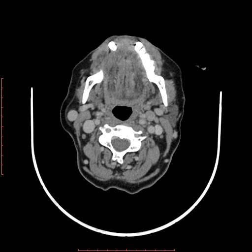 File:Chronic osteomyelitis - maxilla (Radiopaedia 23783-23927 B 22).jpg