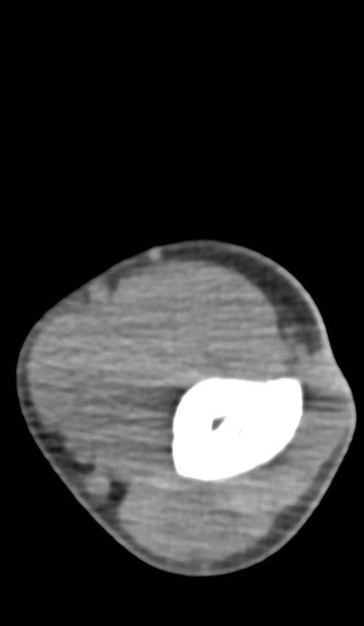 Chronic osteomyelitis of the distal humerus (Radiopaedia 78351-90971 Axial non-contrast 71).jpg