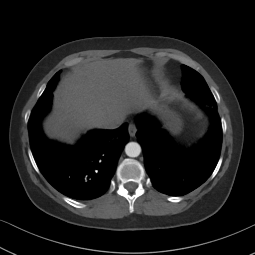 Chronic pulmonary embolus (Radiopaedia 39129-41341 Axial C+ CTPA 82).png