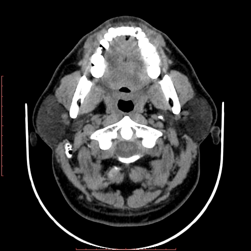 Chronic submandibular sialolithiasis (Radiopaedia 69817-79814 Axial non-contrast 61).jpg