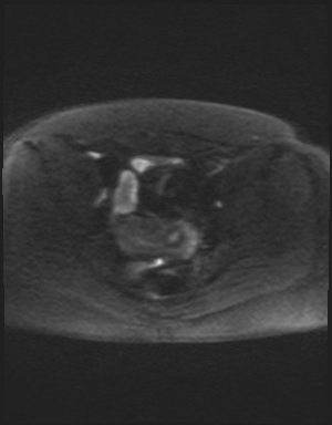 Class II Mullerian duct anomaly- unicornuate uterus with rudimentary horn and non-communicating cavity (Radiopaedia 39441-41755 Axial DWI 48).jpg
