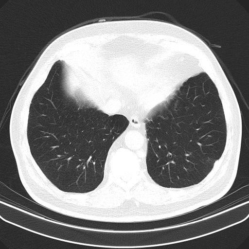 File:Classic complicated silicosis (Radiopaedia 49720-54961 Axial lung window 46).jpg
