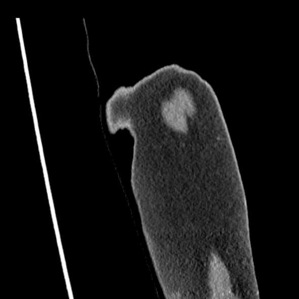 Clear cell chondrosarcoma - humerus (Radiopaedia 63104-71612 Coronal non-contrast 2).jpg