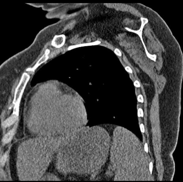 Clear cell chondrosarcoma - humerus (Radiopaedia 63104-71612 D 49).jpg