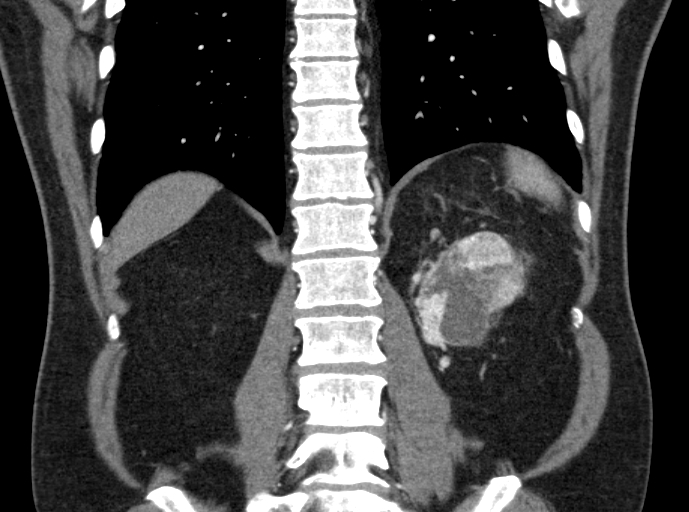File:Clear cell renal cell carcinoma (Radiopaedia 61449-69393 C 38).jpg