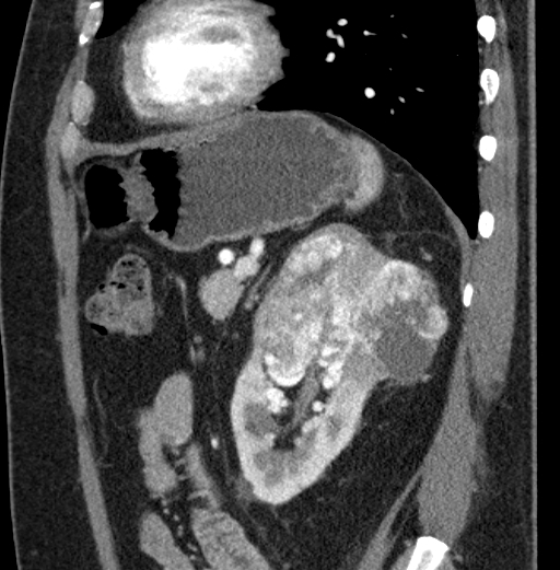 File:Clear cell renal cell carcinoma (Radiopaedia 61449-69393 D 26).jpg