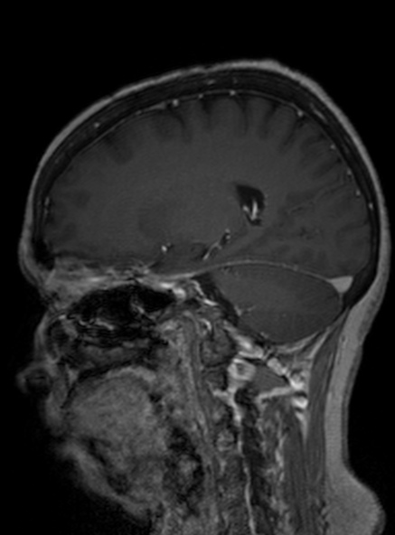 Clival meningioma (Radiopaedia 53278-59248 Sagittal T1 C+ 223).jpg