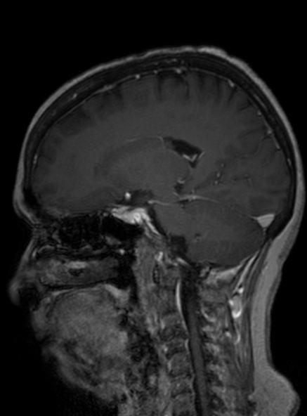 Clival meningioma (Radiopaedia 53278-59248 Sagittal T1 C+ 232).jpg
