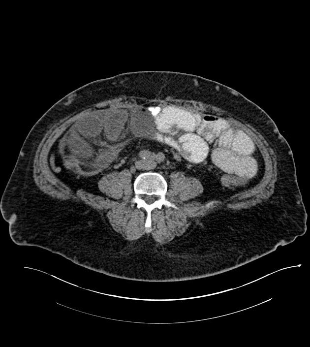 Closed-loop small bowel obstruction-internal hernia (Radiopaedia 78439-91096 Axial non-contrast 97).jpg