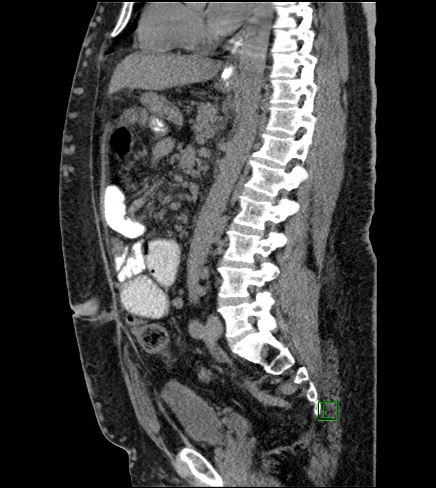 Closed-loop small bowel obstruction-internal hernia (Radiopaedia 78439-91096 C 71).jpg