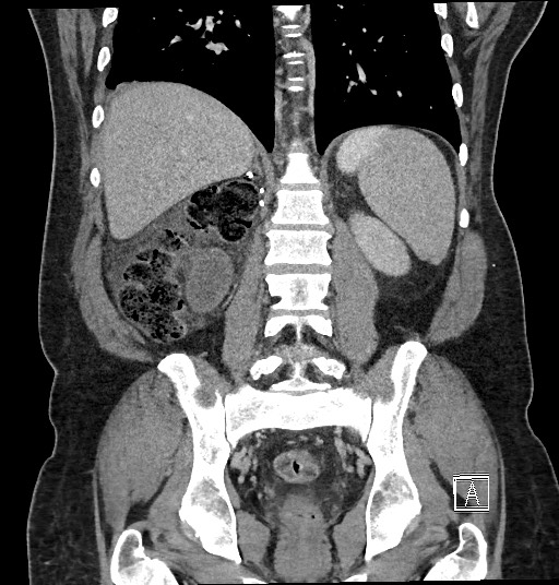 Closed loop obstruction - internal hernia into nephrectomy bed (Radiopaedia 59867-67320 B 97).jpg