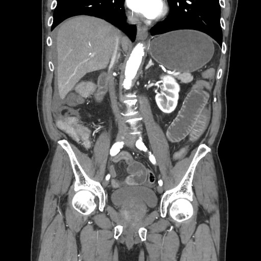 File:Closed loop obstruction due to adhesive band, resulting in small bowel ischemia and resection (Radiopaedia 83835-99023 C 68).jpg