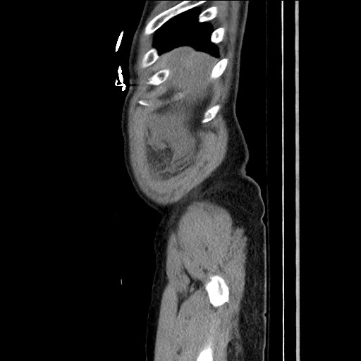File:Closed loop obstruction due to adhesive band, resulting in small bowel ischemia and resection (Radiopaedia 83835-99023 F 28).jpg