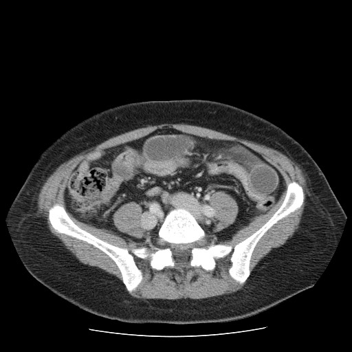 File:Closed loop small bowel obstruction (Radiopaedia 65403-74451 A 54).jpg