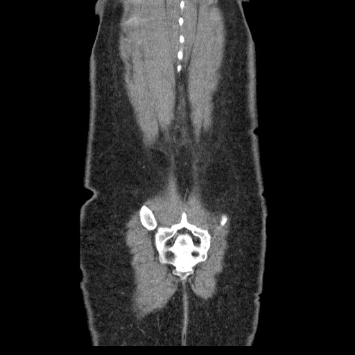 File:Closed loop small bowel obstruction (Radiopaedia 65403-74451 B 97).jpg