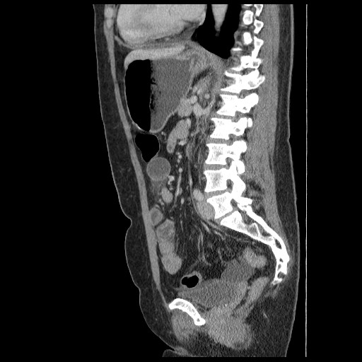 Closed loop small bowel obstruction (Radiopaedia 65403-74451 C 60).jpg