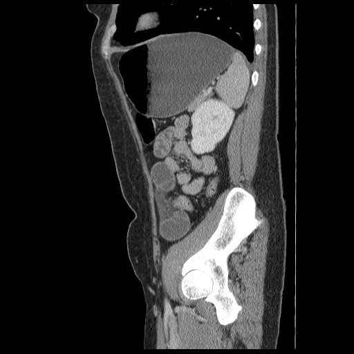 File:Closed loop small bowel obstruction (Radiopaedia 65403-74451 C 82).jpg