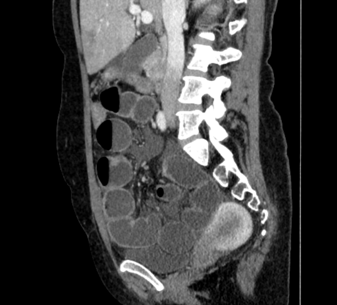 Closed loop small bowel obstruction (Radiopaedia 71211-81508 C 60).jpg