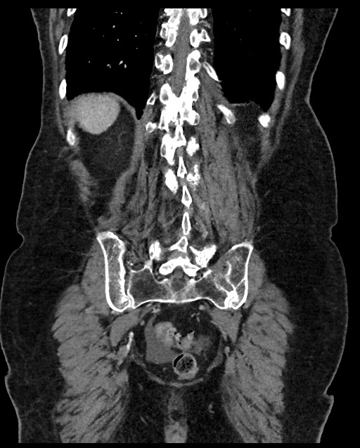Closed loop small bowel obstruction - adhesions (Radiopaedia 59269-66611 B 101).jpg