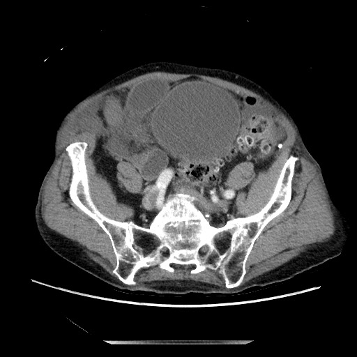 Closed loop small bowel obstruction - adhesive disease and hemorrhagic ischemia (Radiopaedia 86831-102990 A 137).jpg