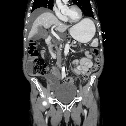 Closed loop small bowel obstruction - adhesive disease and hemorrhagic ischemia (Radiopaedia 86831-102990 B 61).jpg