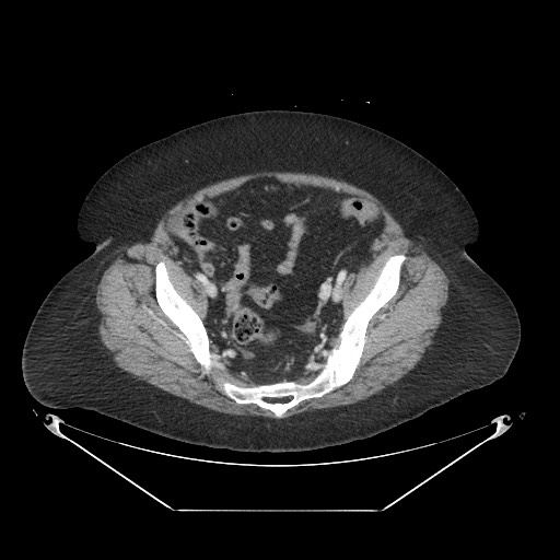 File:Closed loop small bowel obstruction - internal hernia (Radiopaedia 65402-74450 A 108).jpg