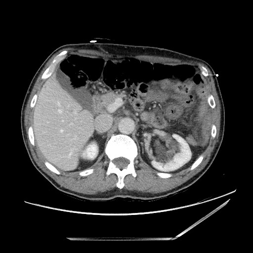 Closed loop small bowel obstruction - omental adhesion causing "internal hernia" (Radiopaedia 85129-100682 A 49).jpg