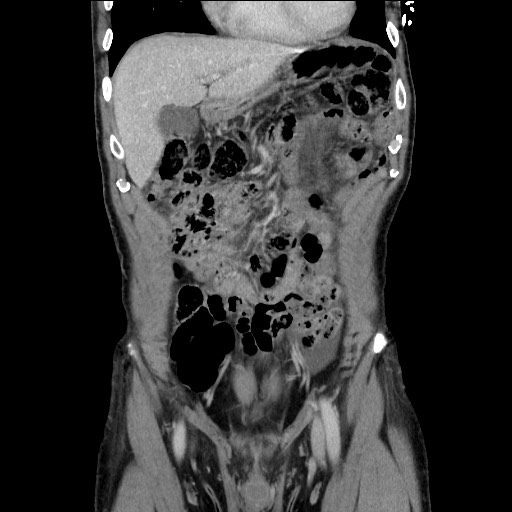 Closed loop small bowel obstruction - omental adhesion causing "internal hernia" (Radiopaedia 85129-100682 B 43).jpg