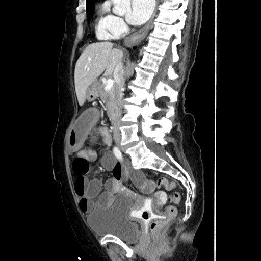 Closed loop small bowel obstruction due to adhesive band, with intramural hemorrhage and ischemia (Radiopaedia 83831-99017 D 100).jpg