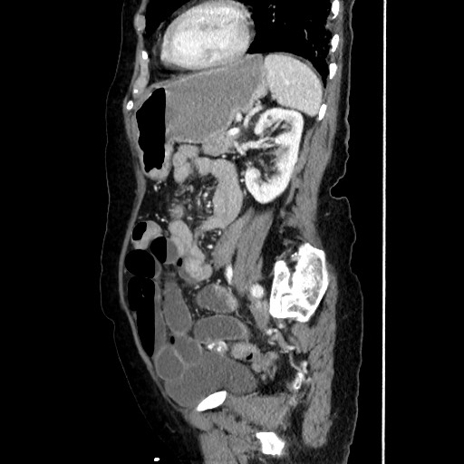 Closed loop small bowel obstruction due to adhesive band, with intramural hemorrhage and ischemia (Radiopaedia 83831-99017 D 129).jpg