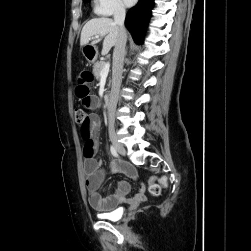 Closed loop small bowel obstruction due to adhesive bands - early and late images (Radiopaedia 83830-99015 C 83).jpg
