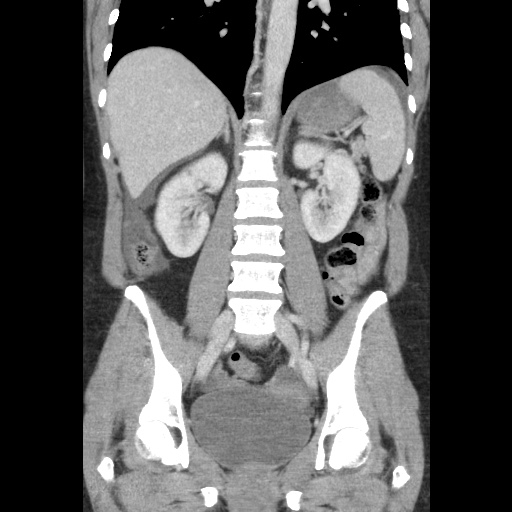 File:Closed loop small bowel obstruction due to trans-omental herniation (Radiopaedia 35593-37109 B 34).jpg