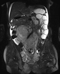 File:Closed loop small bowel obstruction in pregnancy (MRI) (Radiopaedia 87637-104031 Coronal T2 fat sat 32).jpg