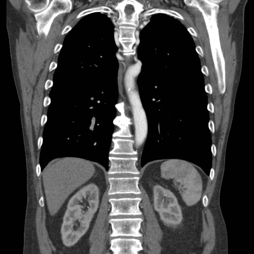 File:Coarctation of the aorta (Radiopaedia 17427-17116 A 31).jpg