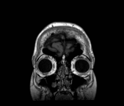 Cochlear incomplete partition type III associated with hypothalamic hamartoma (Radiopaedia 88756-105498 Coronal T1 58).jpg